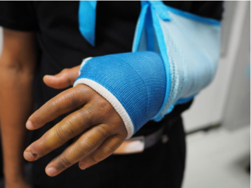 Person with broken arm, concept of injuries covered by workers' comp